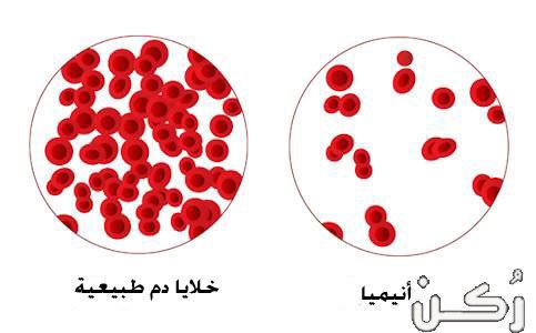علاج أنيميا نقص الحديد والوقاية منها