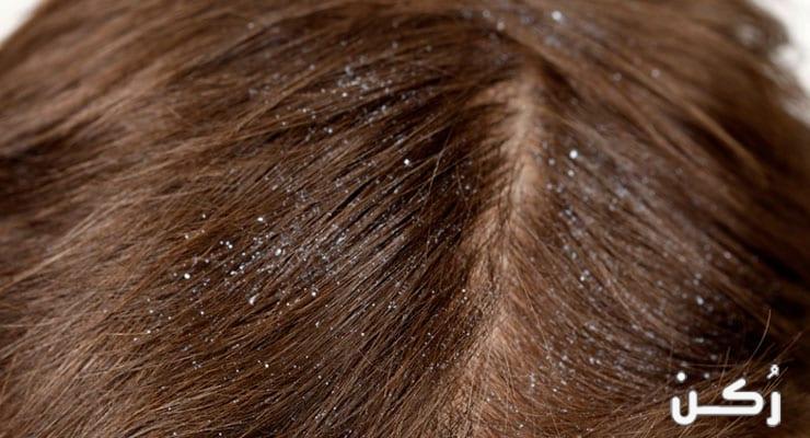 كيفية علاج قشرة الشعر والتخلص منها