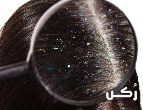كيفية علاج قشرة الشعر والتخلص منها
