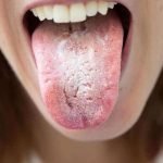 أسباب فطريات اللسان وكيفية علاجها