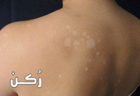ما هي التينيا الملونة وكيف يمكن علاجها