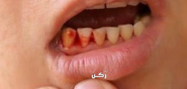 تفسير خروج الدم من الفم في المنام لابن سيرين