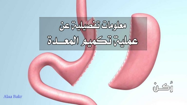 عملية تكميم المعدة
