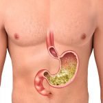 أسباب حرقان المعدة وكيفية علاجه