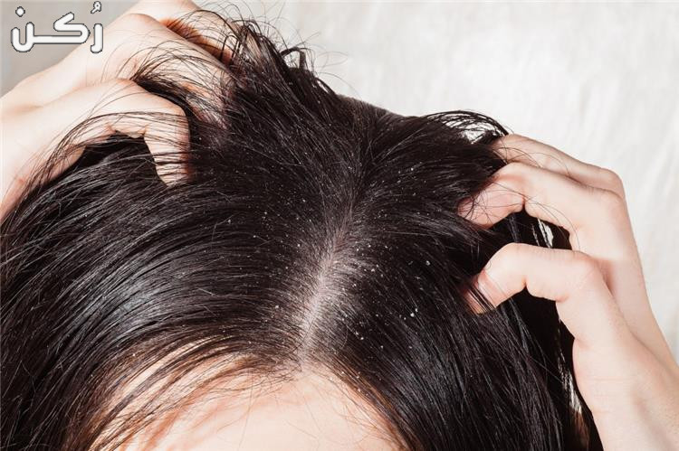 طرق التعامل مع قشرة الشعر المزمنة وعلاجها طبيعيا