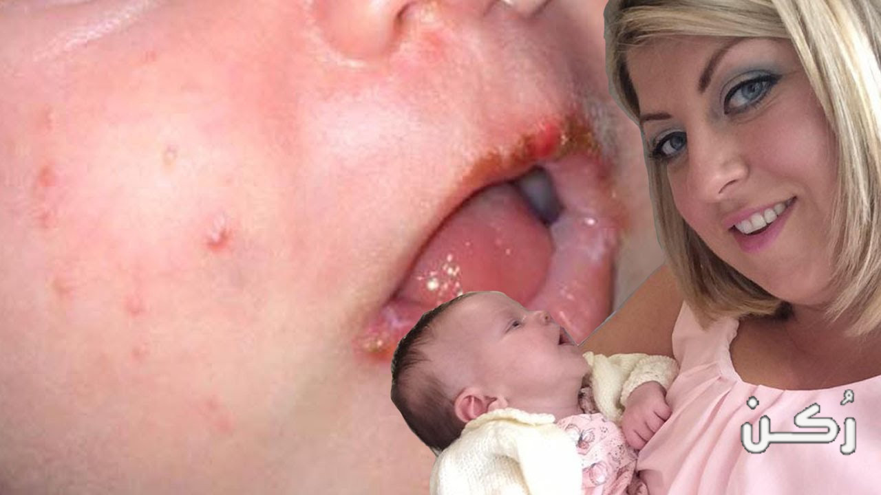 تقبيل الاطفال الرضع خطر يؤدي للوفاة