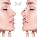تجميل الانف