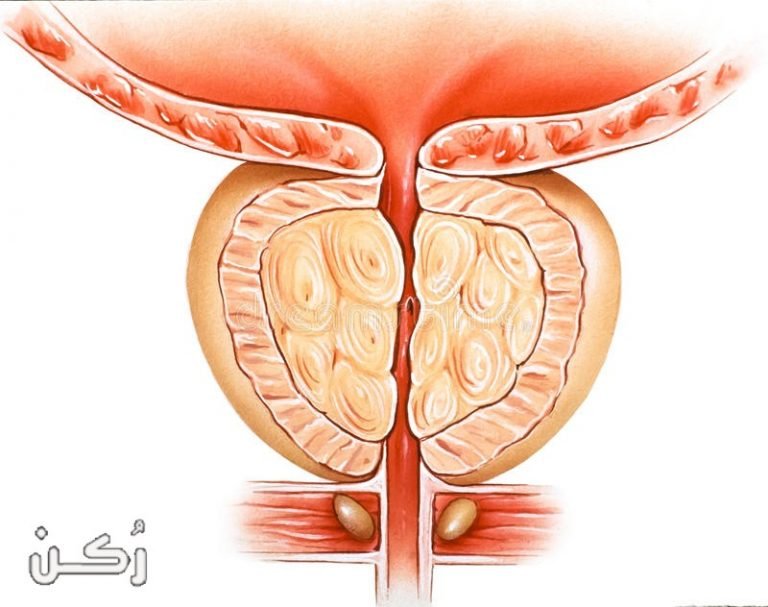 التهاب البروستاتا