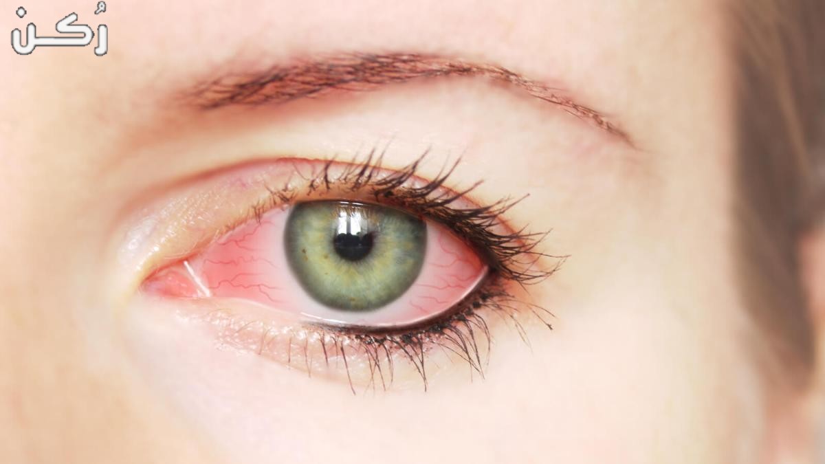 اسباب ارتفاع ضغط العين والأعراض وطرق العلاج