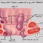 أعراض البواسير الداخلية