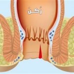 الناسور والباسور والشرخ