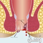 علاج البواسير الخارجية