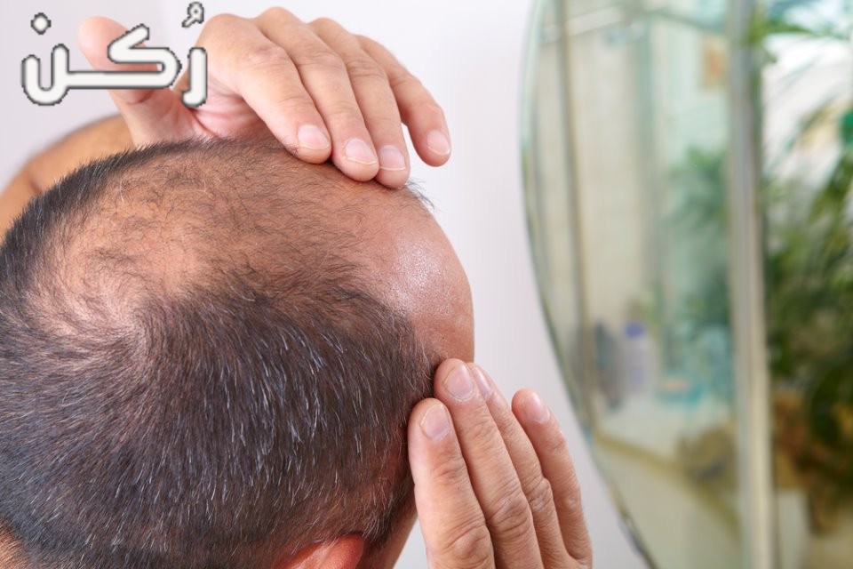 فيناسترايد Finasteride لعلاج تساقط الشعر والآثار الجانبية