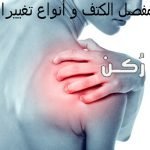 طرق استبدال مفصل الكتف