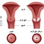 علاج سرطان الرحم