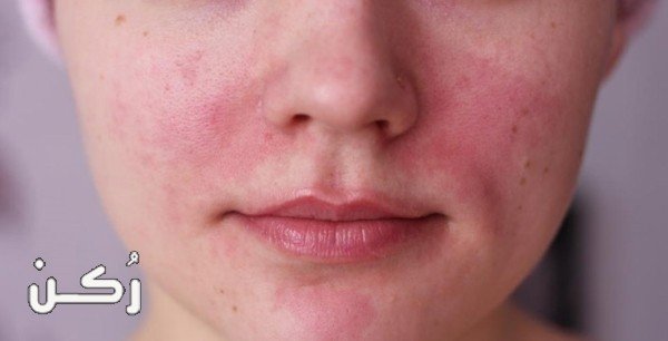 طريقة لعلاج تورم الوجه