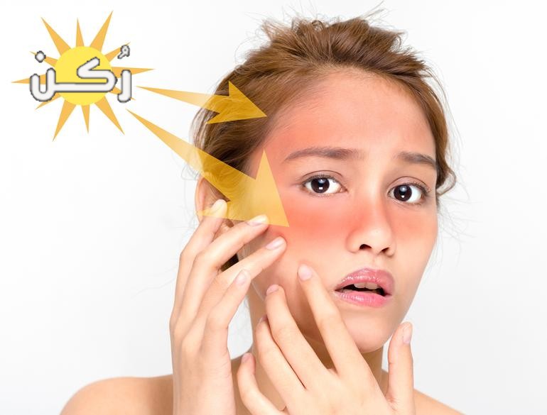 افضل طريقة لعلاج تورم والتهابات الوجه بسبب اشعة الشمس