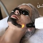 استخدامات الليزر الكربوني