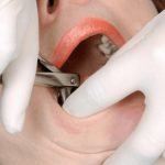 رؤية خلع الضرس