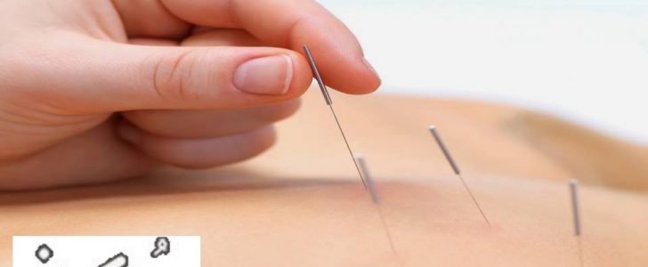 معلومات هامة عن الابرة الصينية وفوائدها واستخداماتها