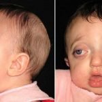 متلازمة فايفر