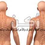 اعوجاج العمود الفقري