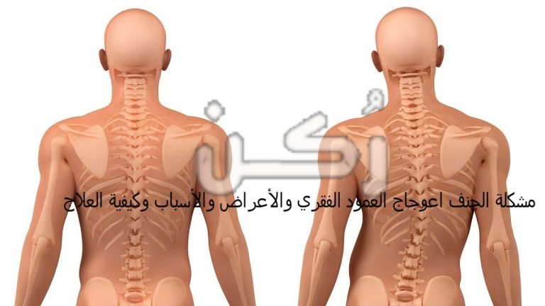 اعوجاج العمود الفقري