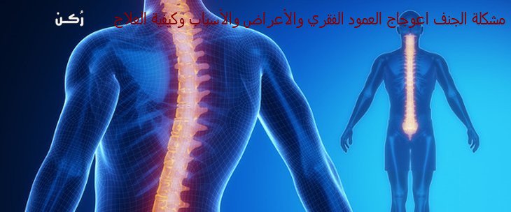 علاج اعوجاج العمود