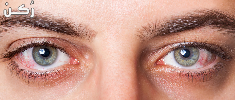 طرق علاج مشكلة جفاف العين