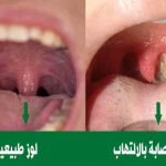 أنواع التهاب اللوزتين