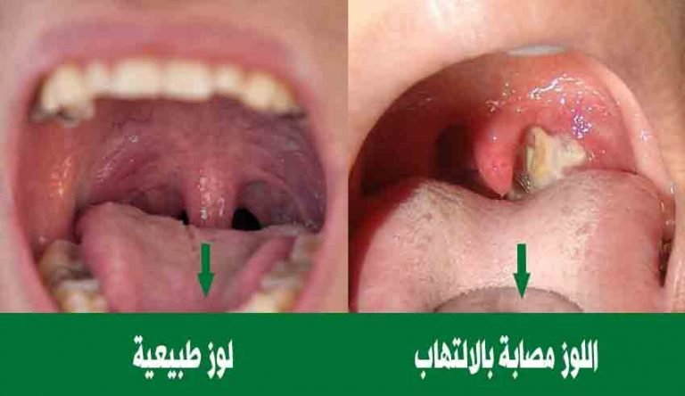 أنواع التهاب اللوزتين