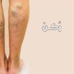 دوالي الأوردة