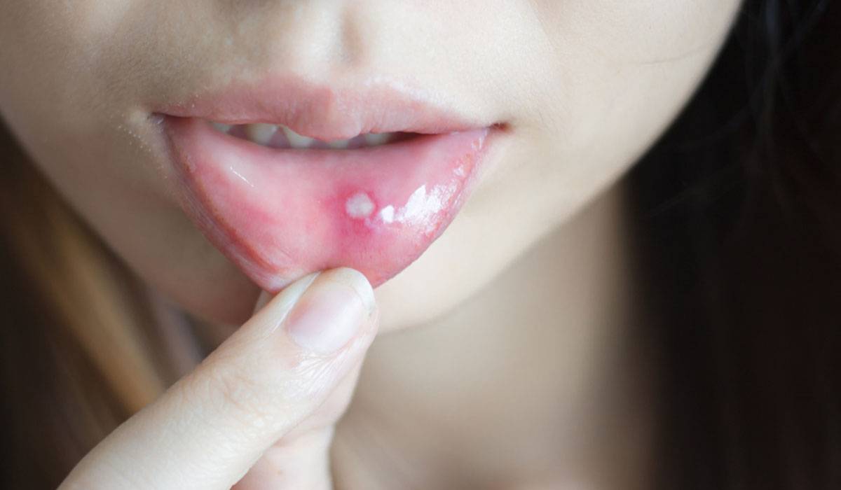أعراض قرحة الفم وما هي أسبابها وكيفية علاجها