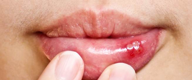 أسباب الإصابة بقرحة الفم