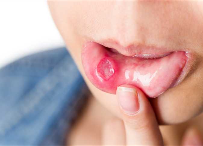 أعراض الإصابة بقرحة الفم