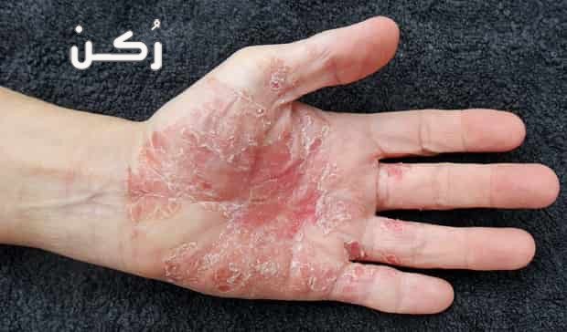 أسباب الإصابة بمرض الصدفية