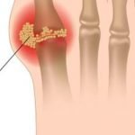 نشرة أقراص زانسيستوب