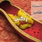 تصلب الشرايين