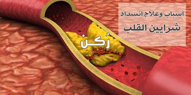 تصلب الشرايين