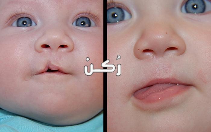 الحنك المشقوق
