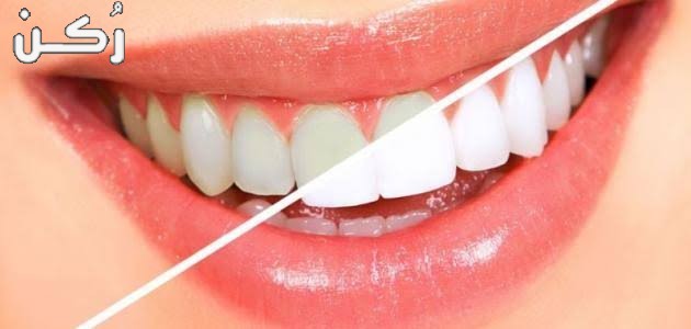 وصفة لتبيض الاسنان