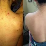 علاج حبوب الظهر