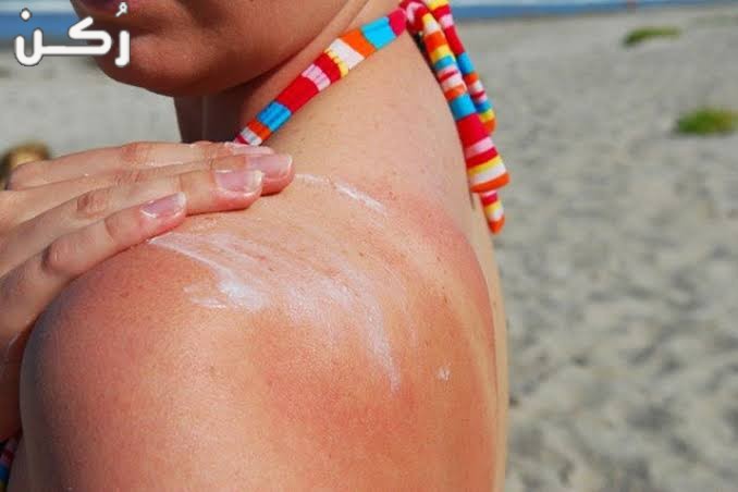 وصفات لعلاج حروق شمس البحر وتفتيح الوجه