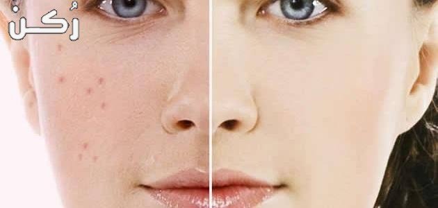 وصفات لتصفية الوجه
