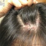 علاج فطريات الشعر