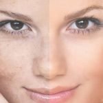 طرق لعلاج تصبغات الجلد