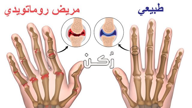 التهاب المفاصل الروماتويدي