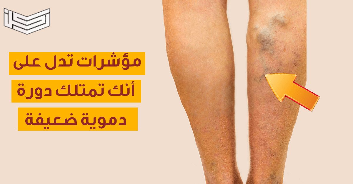 علاج قصور الدورة الدموية